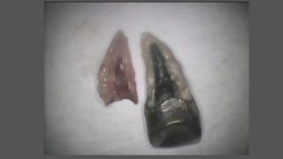 差し歯の土台が咬み合わせ圧力で歯根が割れる