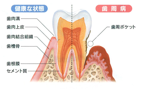歯茎が下がる原因|高松市の歯周病治療なら吉本歯科医院