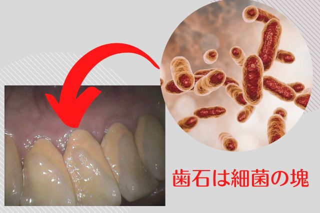 歯石取りで歯茎が下がる|高松市の吉本歯科医院