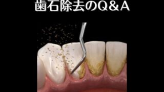 歯石除去でよく頂くご質問