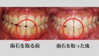 歯石を取った後に前歯に隙間ができた