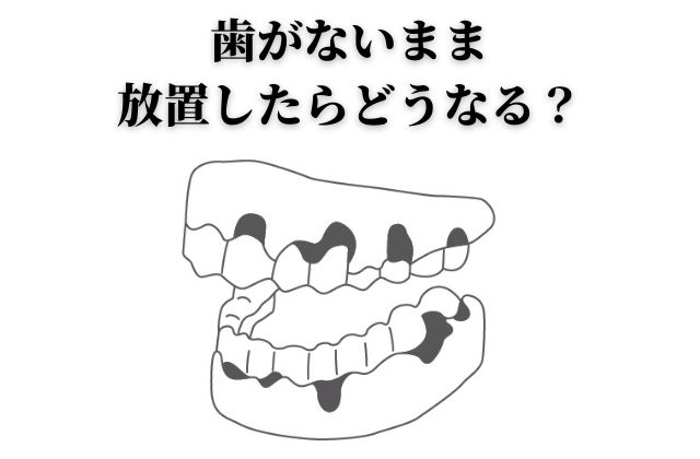 歯を失った場合の３つの治療法|抜歯後の治療の解説｜高松市の吉本歯科医院