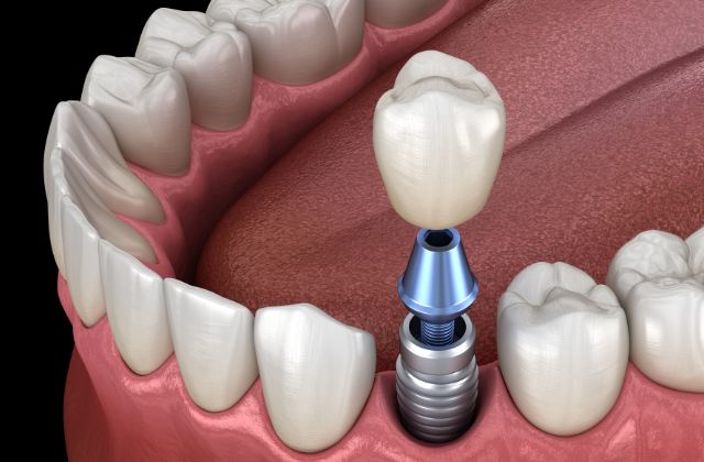 歯を失った場合の３つの治療法|抜歯後の治療の解説｜高松市の吉本歯科医院