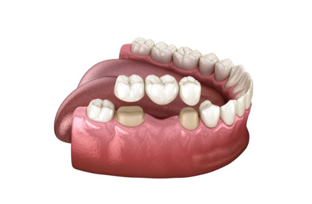 歯を失った場合の３つの治療法|抜歯後の治療の解説｜高松市の吉本歯科医院