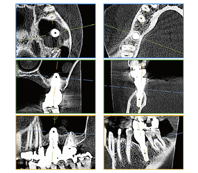 高松市でインプラント治療なら咬み合わせ専門 吉本歯科医院