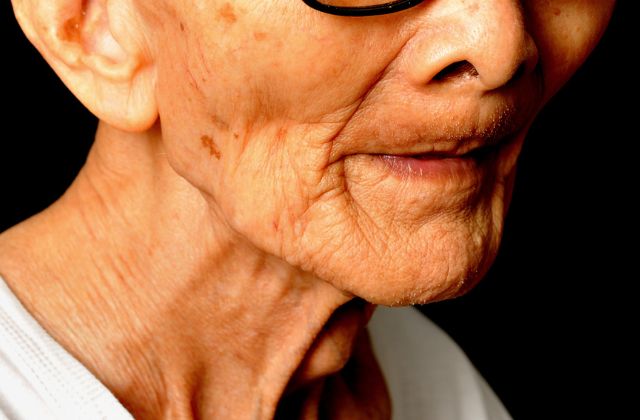 入れ歯が合わなくなる原因は?|高松市の入れ歯なら咬み合わせ専門 吉本歯科医院