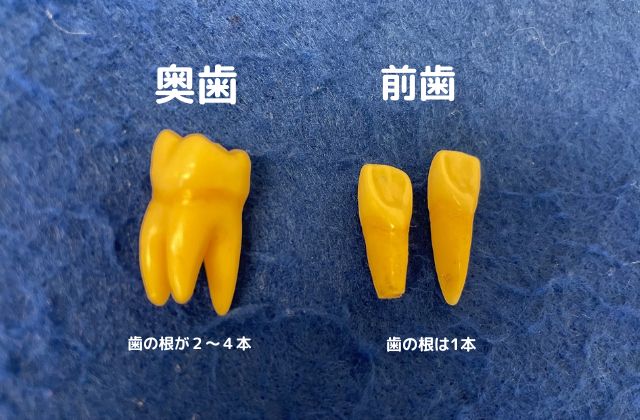 歯を抜いた後の治療法｜高松市の歯科｜吉本歯科医院