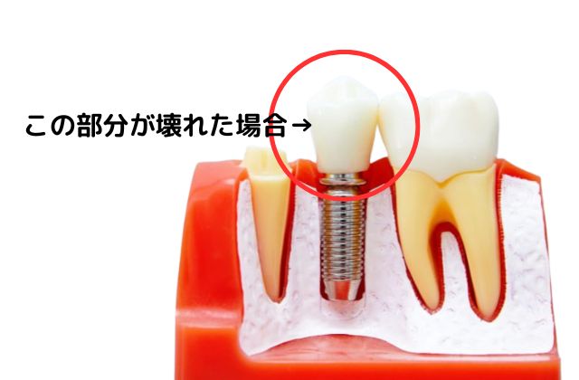 他医院で受けたインプラントの修復・治療・メインテナンスの相談｜高松市の吉本歯科医院