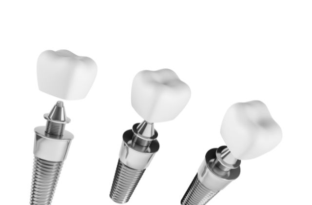 他医院で受けたインプラントの修復・治療・メインテナンスの相談｜高松市の吉本歯科医院