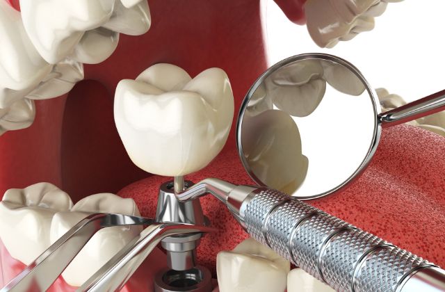 他医院で受けたインプラントの修復・治療・メインテナンスの相談｜高松市の吉本歯科医院