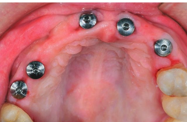 他医院で受けたインプラントの修復・治療・メインテナンスの相談｜高松市の吉本歯科医院