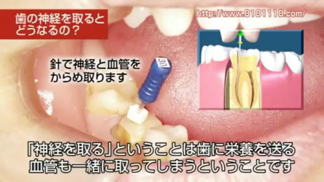 歯の神経を取らずに治療したい｜高松市の削らず治す虫歯治療なら吉本歯科医院