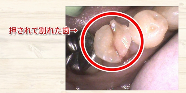 痛くない虫歯治療なら高松市の吉本歯科医院