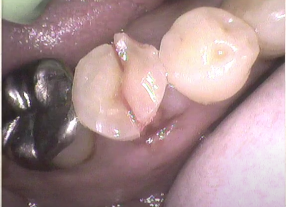 痛くない虫歯治療なら高松市の吉本歯科医院