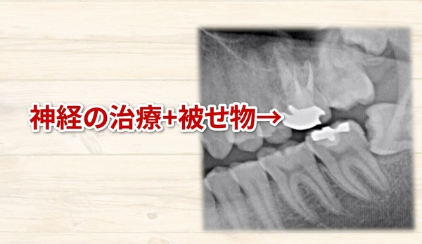 痛くない虫歯治療なら高松市の吉本歯科医院