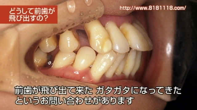 前歯の歯並びが崩れてきた、前歯が前に飛び出してきた｜高松市のかみあわせ専門　吉本歯科医院