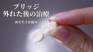 ブリッジでつないでいる歯が取れてしまった後の治療