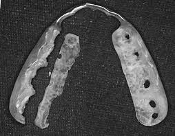 歯を失う原因第3位の歯根破折｜歯を抜きたくない｜高松市のかみあわせ専門　吉本歯科医院