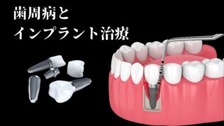 歯周病で歯がグラグラ。歯周病とインプラント治療