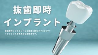 抜歯したその日にインプラントができる治療方法