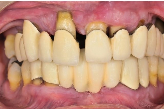 重度歯周病でもインプラント治療ができるのか?|高松市の骨がない場合のインプラントなら吉本歯科医院