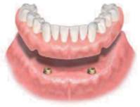 高松市で外れる入れ歯でお悩みなら吉本歯科医院｜入れ歯を固定するインプラントオーバーデンチャー