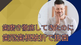 歯磨きを徹底してきたのに歯冠・歯根破折で抜歯