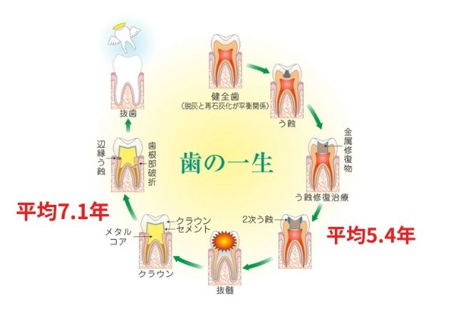 ブリッジ治療の寿命|両端の正常は歯への負担を減らしたい|高松市の吉本歯科医院