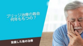 ブリッジ治療は何年もつ？寿命は？