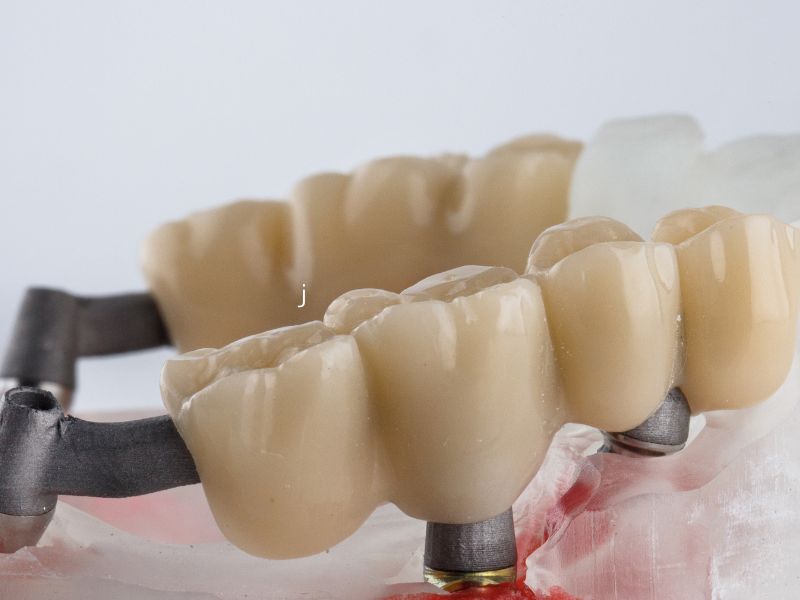 ブリッジ治療の寿命｜両端の正常は歯への負担を減らしたい｜高松市の吉本歯科医院