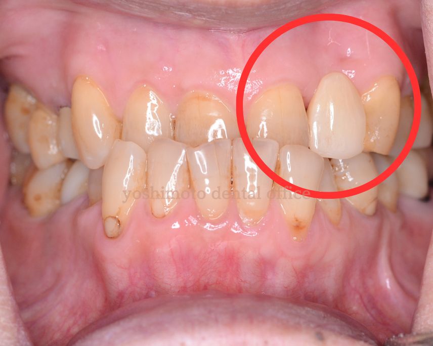 歯を少ししか削らないジルコアに接着ブリッジなら高松市のかみ合わせ専門歯科　吉本歯科医院