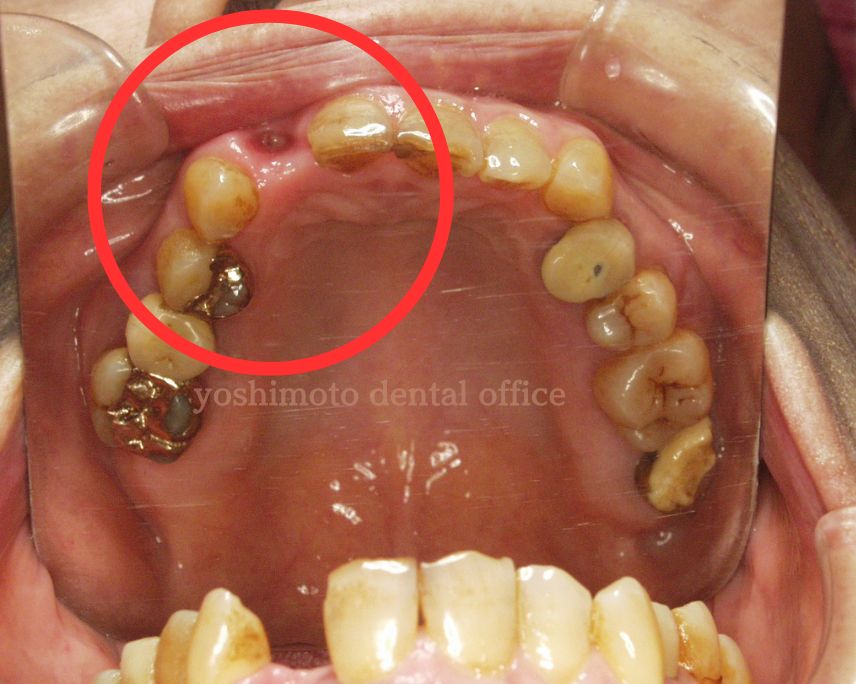 歯を少ししか削らないジルコアに接着ブリッジなら高松市のかみ合わせ専門歯科　吉本歯科医院