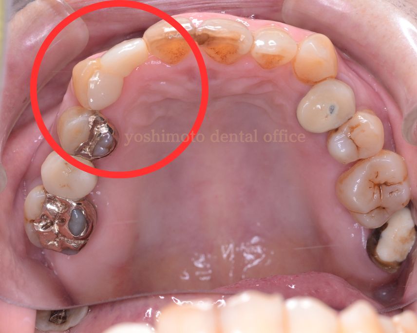 歯を少ししか削らないジルコアに接着ブリッジなら高松市のかみ合わせ専門歯科　吉本歯科医院