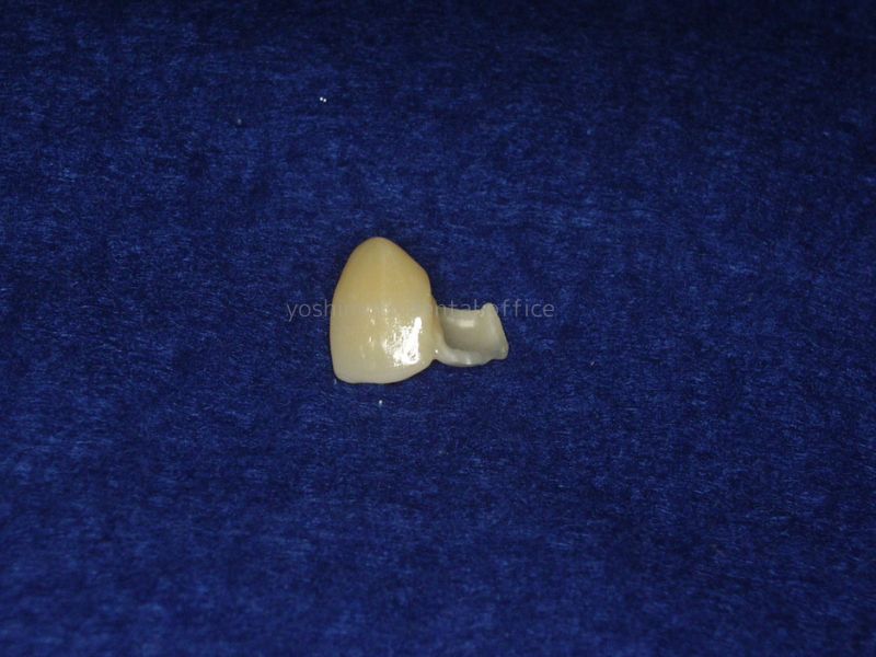 歯を削る量が10分の1程度ですむジルコニア接着ブリッジ