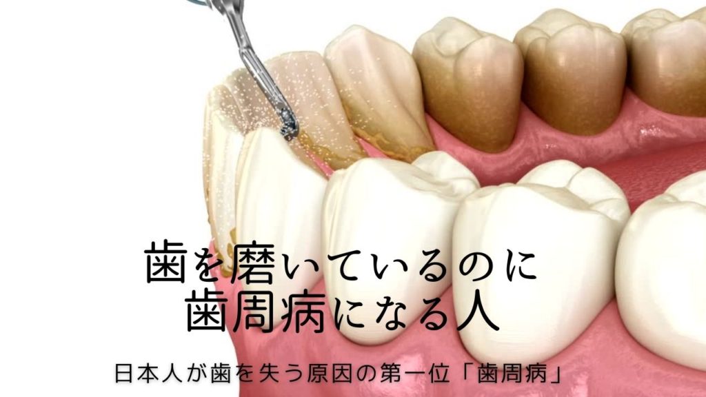 日本人が歯を失う原因第一位の歯周病|高松市の吉本歯科医院