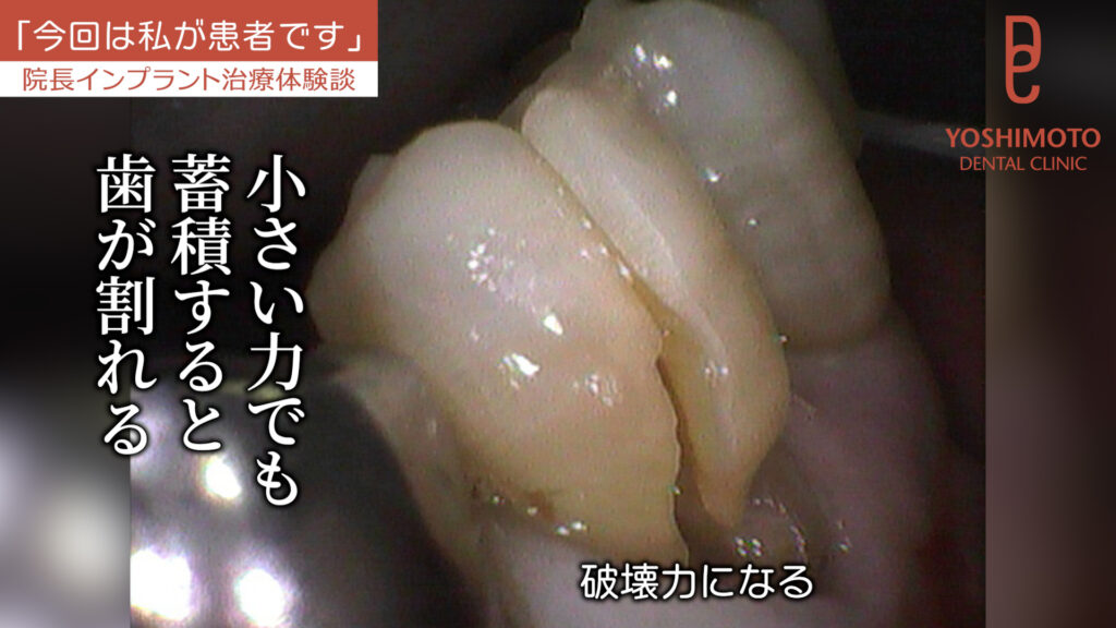 50代から不安になる「歯周病で歯を失うかも?」|香川県高松市の歯科医が教える予防と治療法