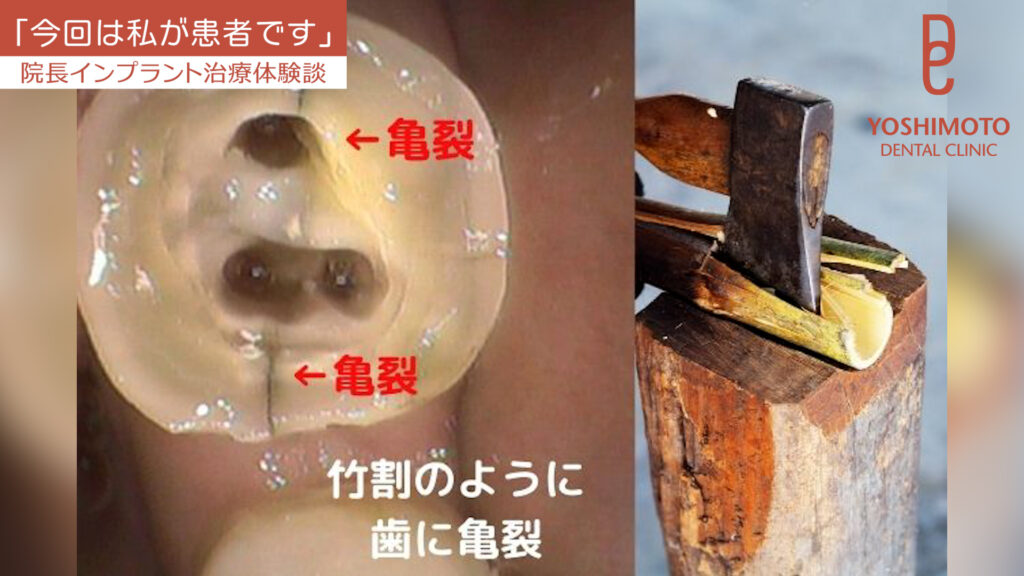 50代から不安になる「歯周病で歯を失うかも?」|香川県高松市の歯科医が教える予防と治療法