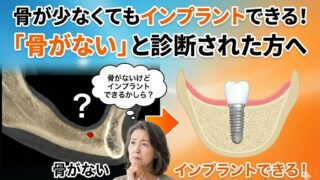 【香川県】骨が少なくてもインプラントできる！「骨がない」と診断された方へ