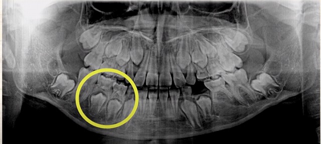 【香川県高松市】10人に1人が悩む！？先天性欠如歯とは｜放置すると危険な理由と治療法【吉本歯科医院】