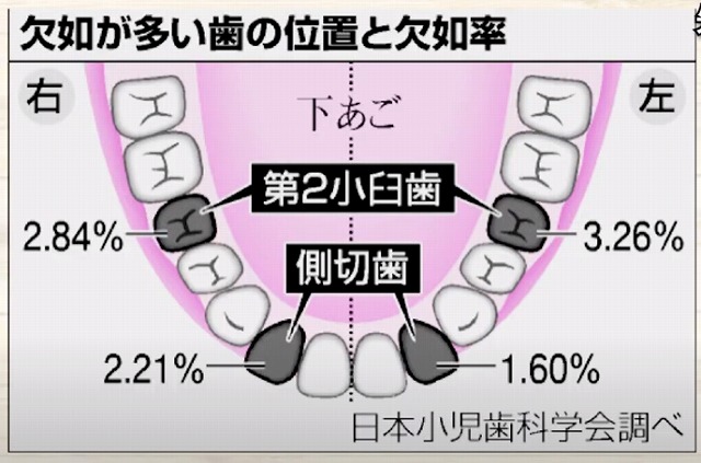 【香川県高松市】10人に1人が悩む！？先天性欠如歯とは｜放置すると危険な理由と治療法【吉本歯科医院】