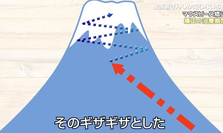 マウスピース矯正をはやく仕上げる方法｜香川県高松市のかみあわせ専門　吉本歯科医院