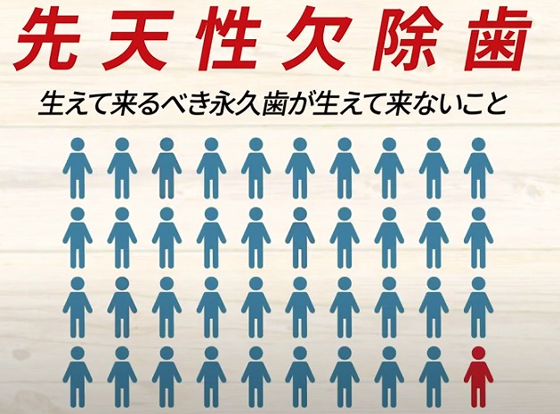 【香川県高松市】10人に1人が悩む！？先天性欠如歯とは｜放置すると危険な理由と治療法【吉本歯科医院】