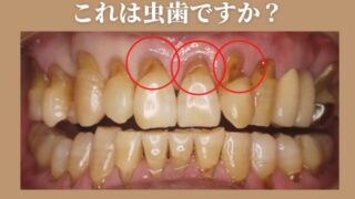 歯の根元が削れてる！？その正体は「くさび状欠損」かもしれません