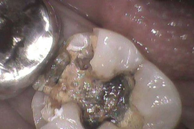 香川県高松市の吉本歯科医院では、銀歯ではなく体に優しい治療を提供。金属アレルギーや再発リスクを防ぐメタルフリー治療について詳しく解説。
