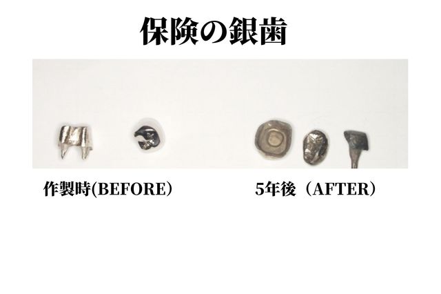 香川県高松市の吉本歯科医院では、銀歯ではなく体に優しい治療を提供。金属アレルギーや再発リスクを防ぐメタルフリー治療について詳しく解説。