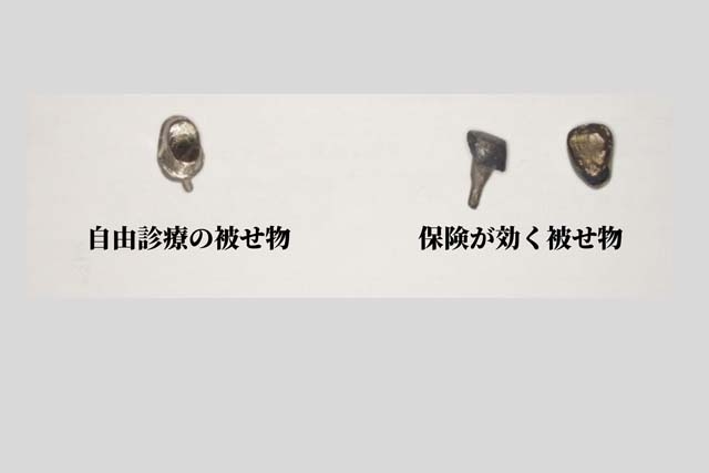 香川県高松市の吉本歯科医院では、銀歯ではなく体に優しい治療を提供。金属アレルギーや再発リスクを防ぐメタルフリー治療について詳しく解説。