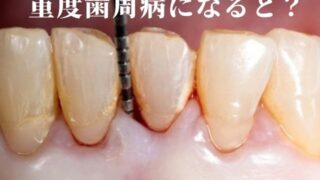 重度の歯周病になると「歯を支える骨」が溶け始めています