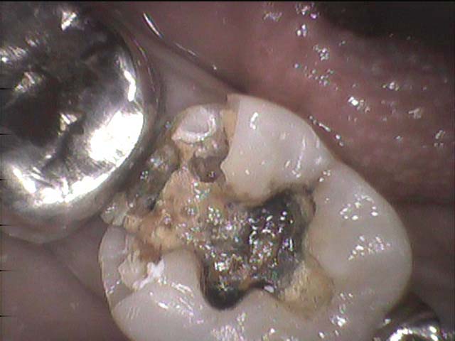銀歯・合金の被せ物や詰め物の現状｜香川県高松市の噛み合わせ専門歯科医院　吉本歯科医院