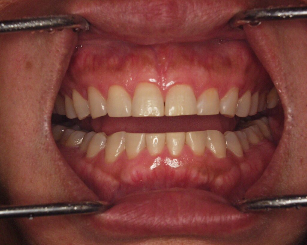 丈夫な歯でも割れる|50代からの歯のリスク、噛み合わせがカギ【香川県高松市の咬み合わせ専門歯科 吉本歯科医院】