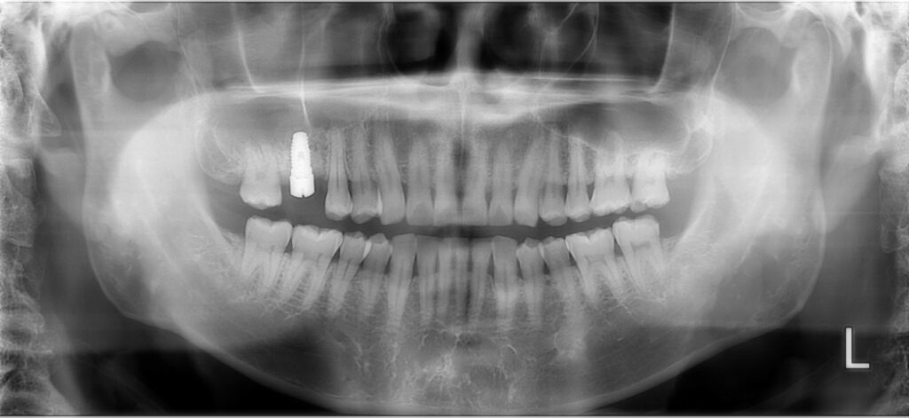 丈夫な歯でも割れる|50代からの歯のリスク、噛み合わせがカギ【香川県高松市の咬み合わせ専門歯科 吉本歯科医院】